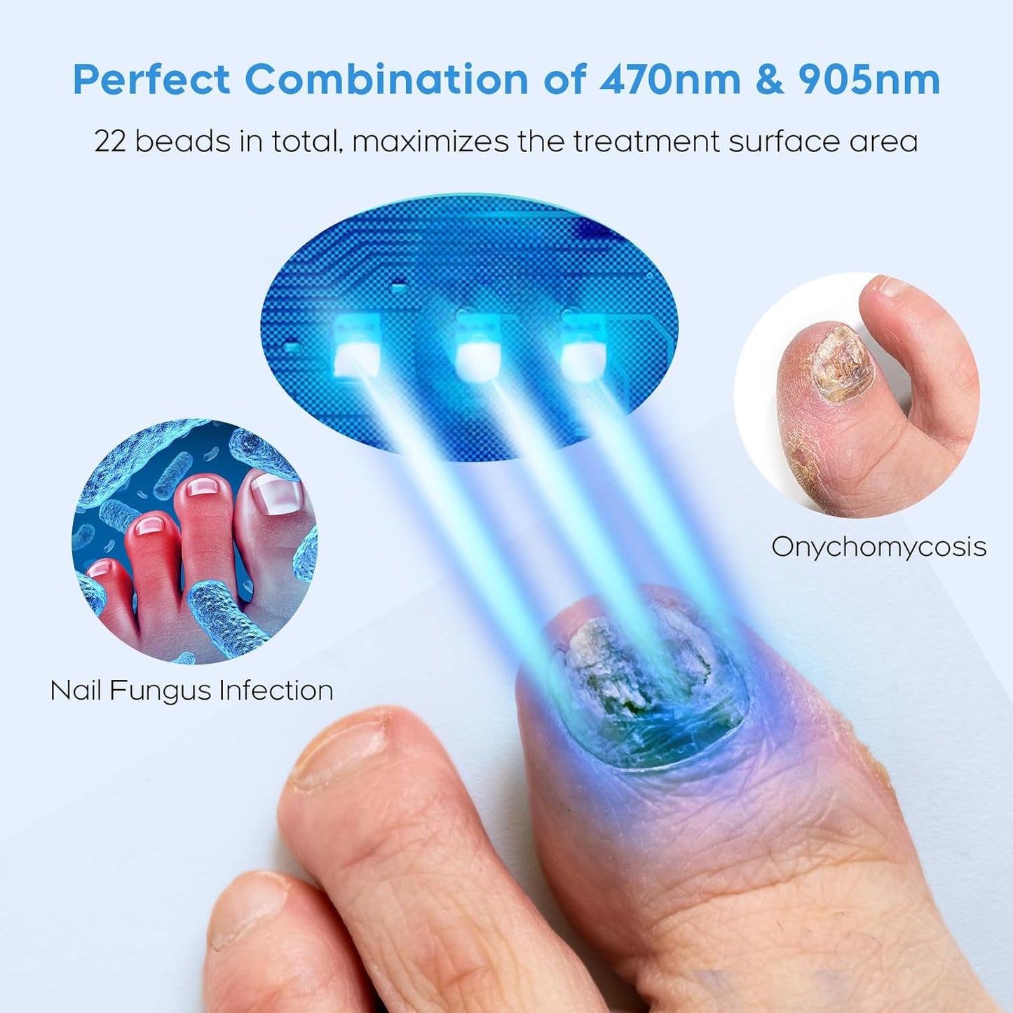 ZZP Nail Fungus Laser Treatment Device for Multiple Toenail, 905nm Infrared Light + 470nm Blue Light Toe Nail Fungus Device for Home Use, Highly Effective and Safe