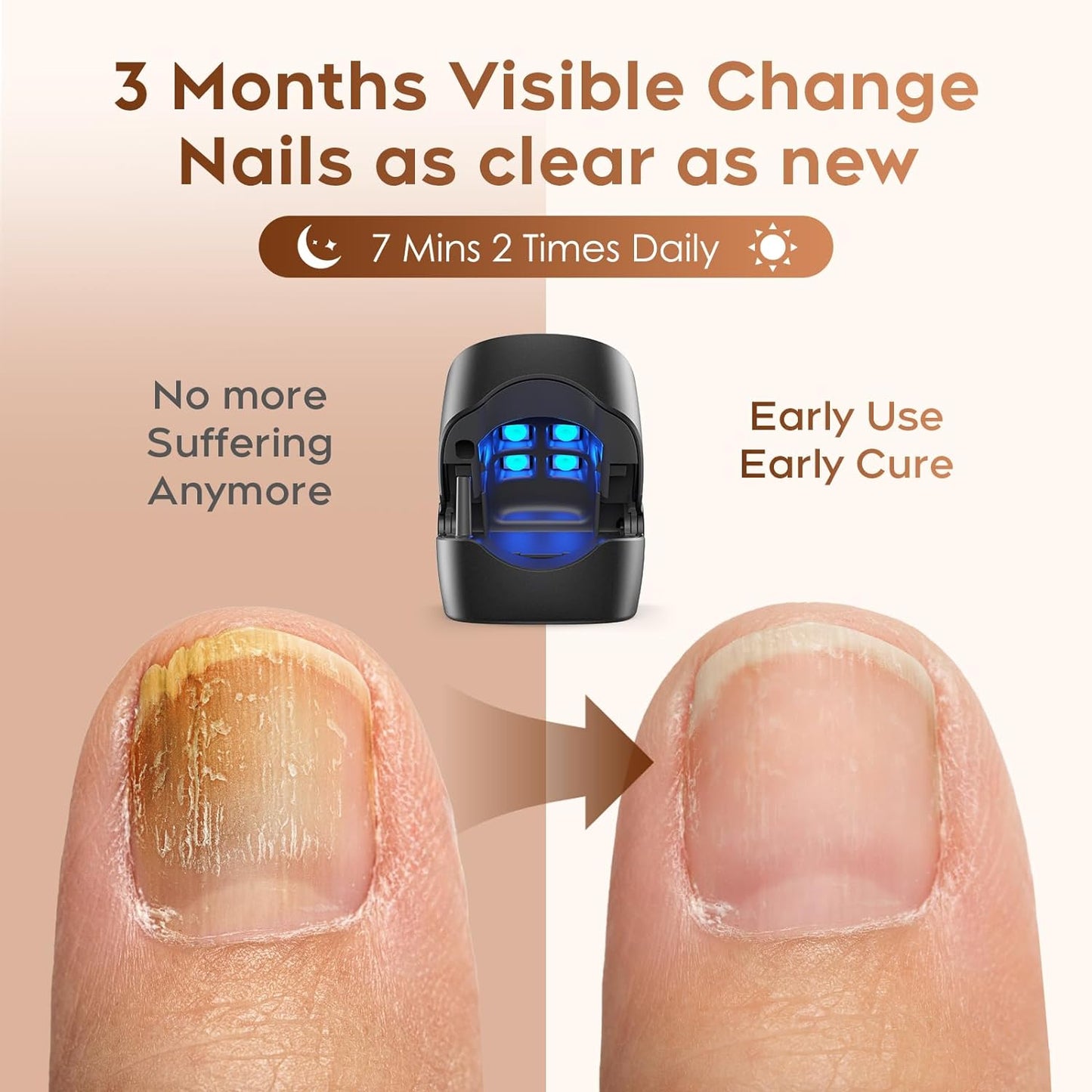 TPJOER Nail Fungus Laser Treatment Device, Home Use Laser Toenail Fungus Treatment Device, Elderly Easy to Use, Toenail Fungus Laser Onychomycosis Treatment, for Thickened and Yellowed Nails