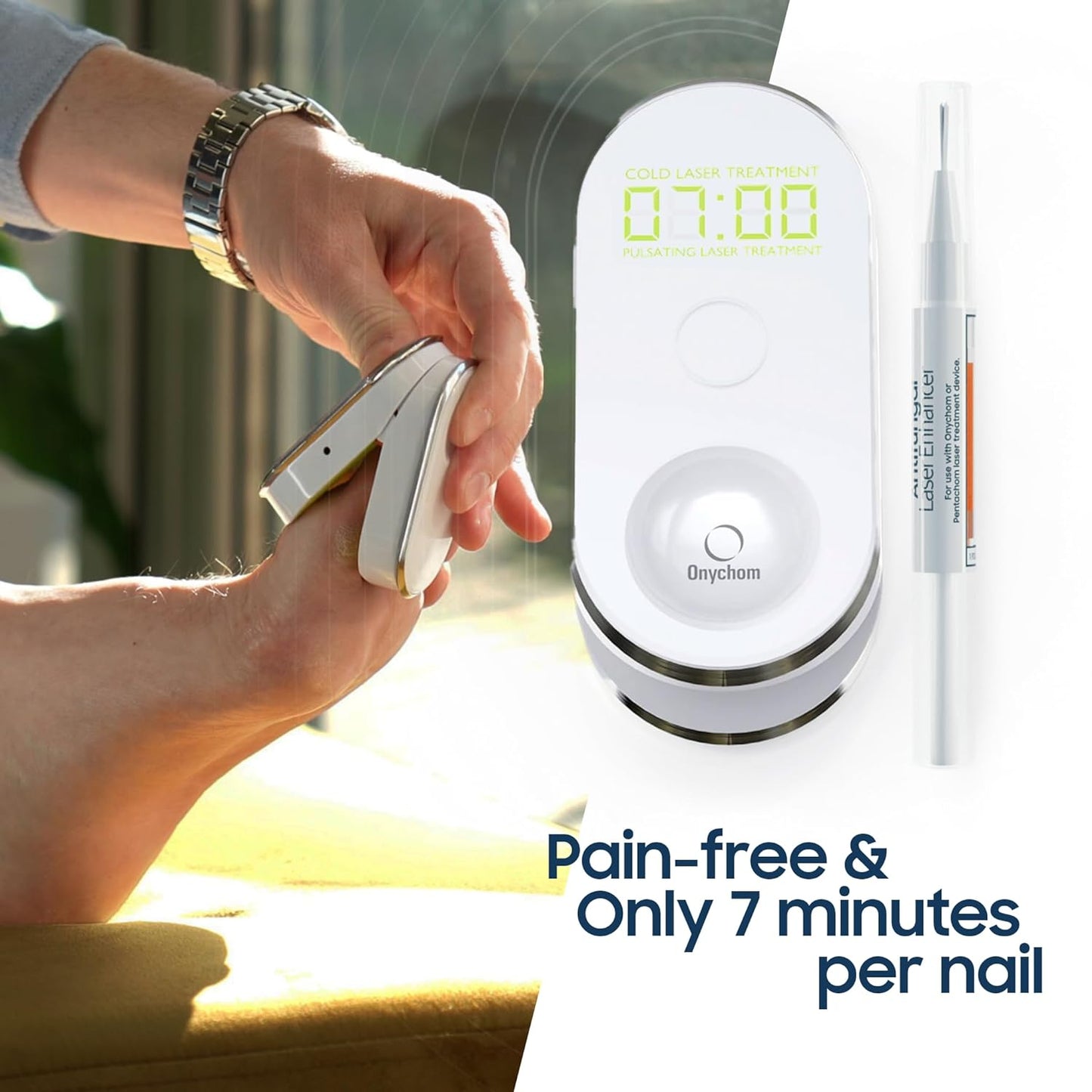 Onychom - Toenail Fungus Laser Treatment Device - Pain-Free Nail Fungus Treatment for Toenails and Fingernails - Includes Free Extra-Strength Antifungal Laser Enhancer Serum