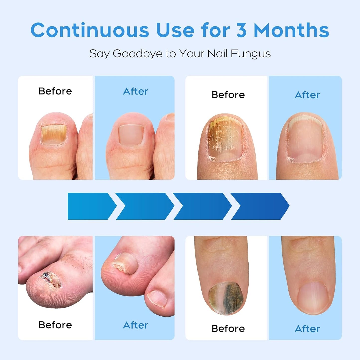 ZZP Nail Fungus Laser Treatment Device for Multiple Toenail, 905nm Infrared Light + 470nm Blue Light Toe Nail Fungus Device for Home Use, Highly Effective and Safe