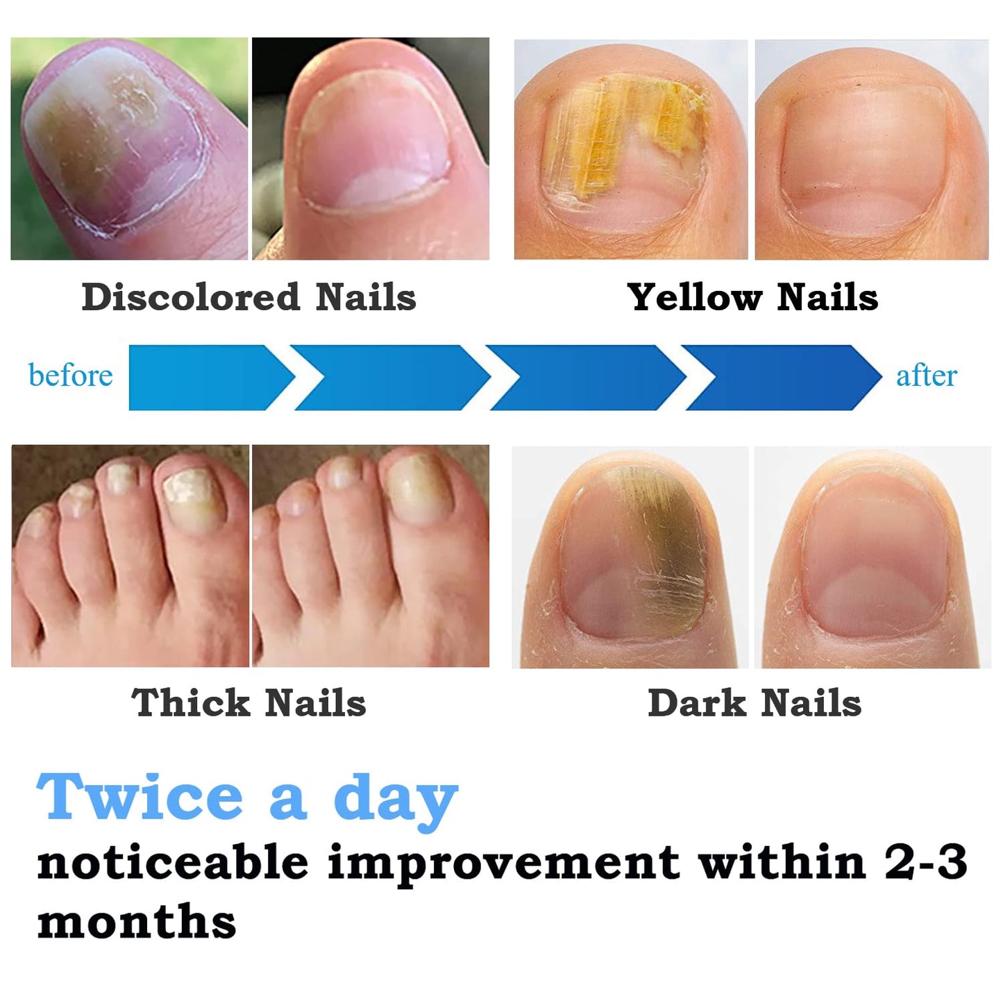 Secfanya Nail Fungus Cleaning Laser Treatment Device, Using 910nm Infrared and 470nm Blue Light, Effective Treatment of Damaged, Discolored, Thickened Toenails
