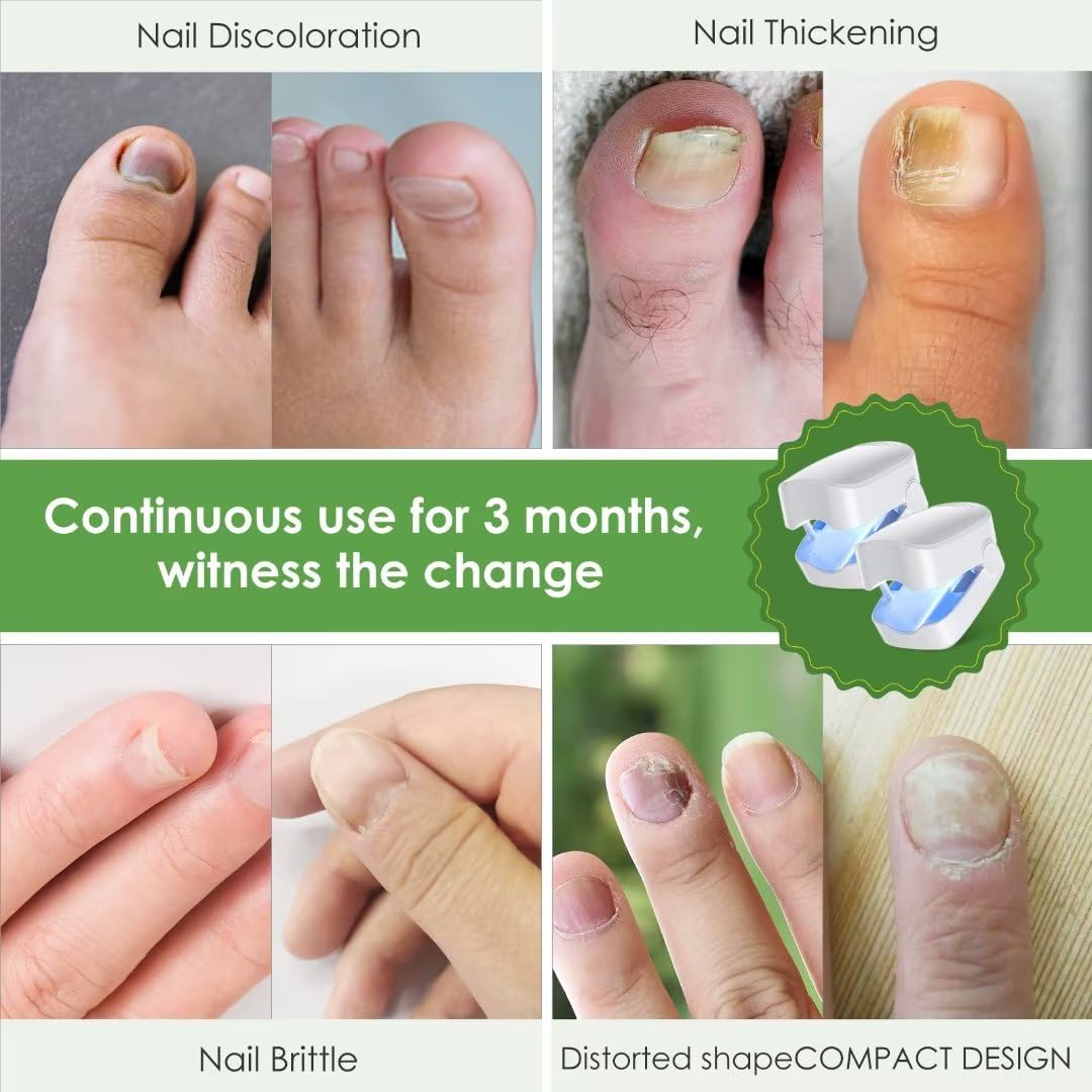 SUNCKY 2 Pack Nail Fungus Laser Treatment Device, FSA or HSA eligible Laser Fungus Nail Treatment for Toenail and Fingernail, Blue Light Therapy for Onychomycosis Damaged Discolored Thick Toenail