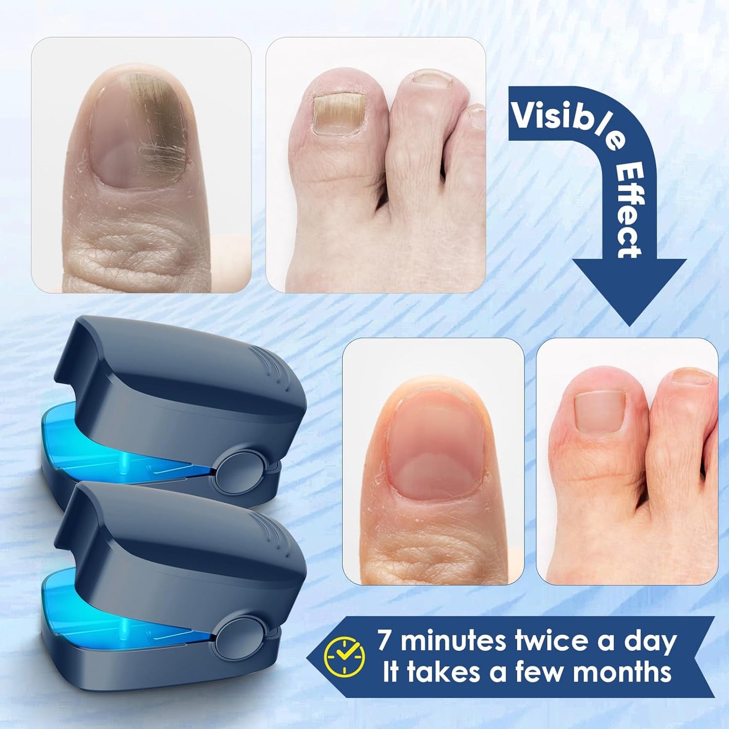 URMIIM 2 Pack Nail Fungus Cleaning Laser Treatment Device for Onychomycosis, Highly Effective Laser Device for Finger/Toenails, FSA HSA Eligible, Improve Appearance of Discolored, Brittle & Cracked Nails