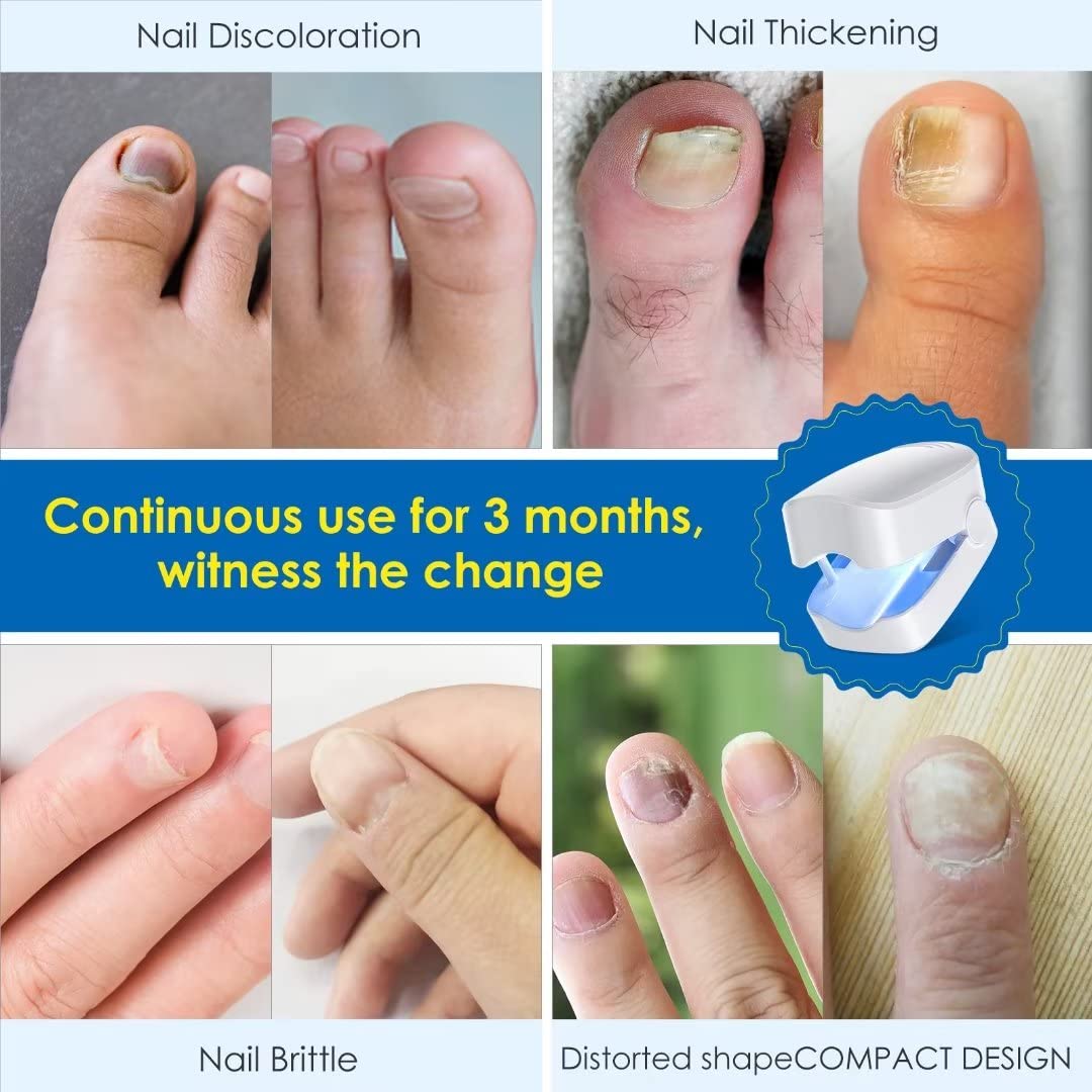 SUNCKY Nail Fungus Cleaning Laser Device, FSA or HSA eligible Nail Fungus Laser Treatment for Damaged Discolored Thick Toenails & Fingernails, Effective Rechargeable Nail Fungus Remover for Home Use