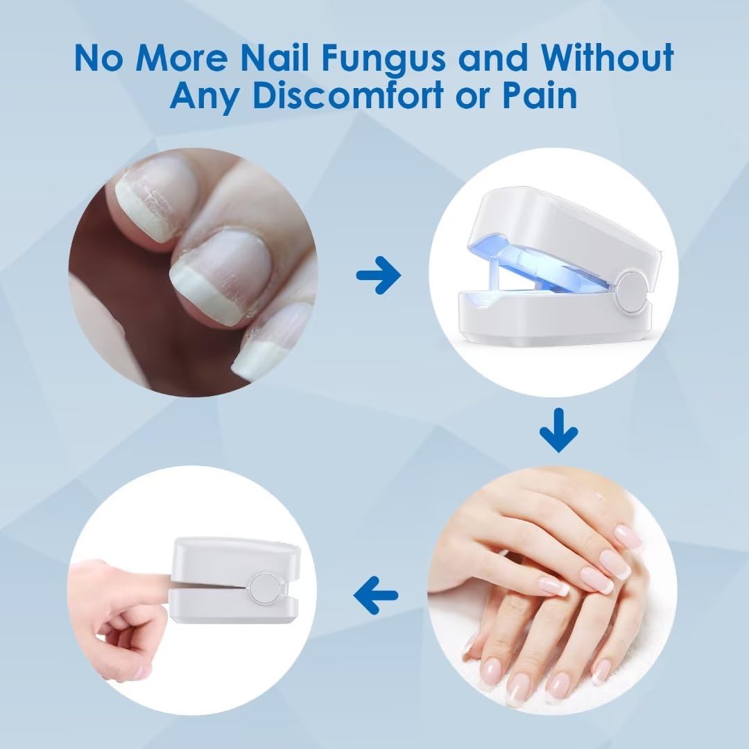 ZZP Nail Fungus Laser Treatment Device -Pain-Free, and Effective Home Treatment, No More Embarrassment