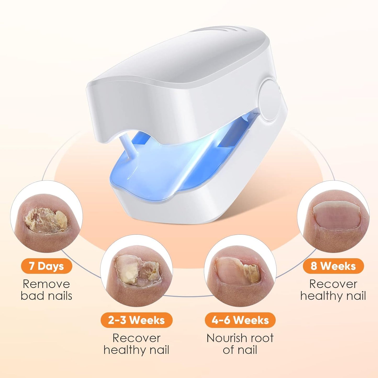 URMIIM Nail Fungus Cleaning Laser Device for Onychomycosis, Nail Fungus Laser Treatment for Fingernails and Toenails, Treatment for Home Use by 910nm Infrared Light + 470nm Blue Light, FSA HSA Eligible