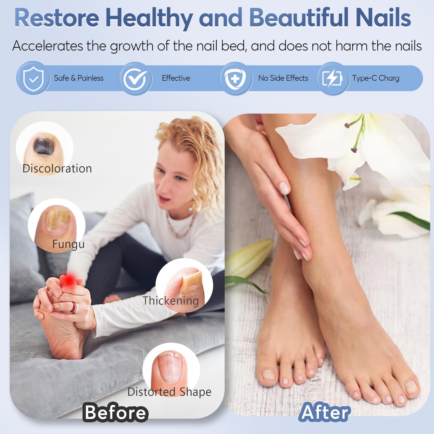 Nail Fungus Laser Treatment Led Light Device - B0DTHCRQFR