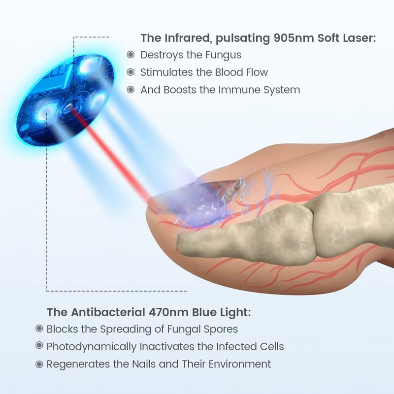 EIXIO Toenail Fungus Treatment Nail Fungus Cleaning LaserDevice for Onychomycosis Nail Fungal Treatment for Fingernail & Toenail Effective for Toe Fungus Nail Treatment