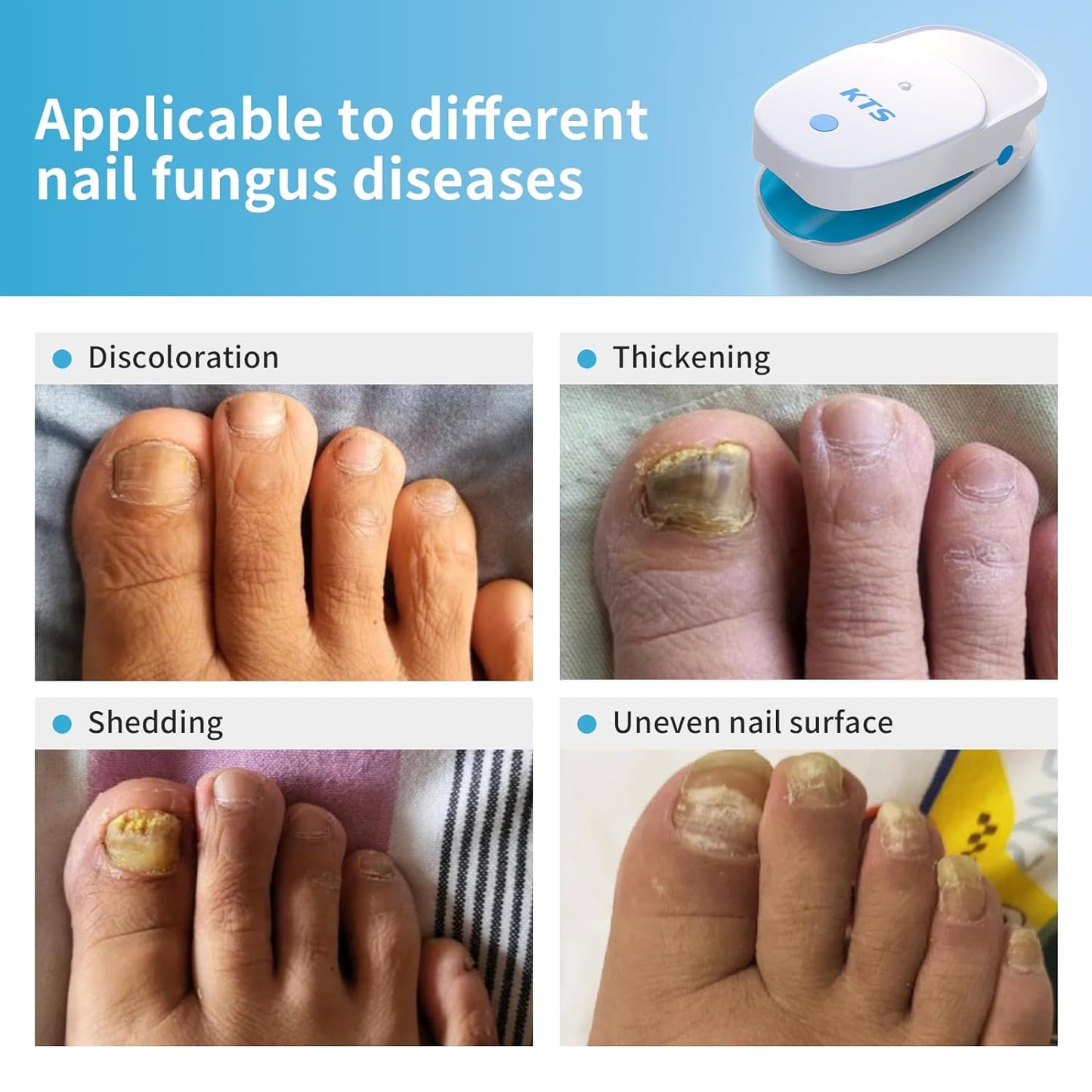 KTS Nail Fungus Laser Treatment Device,Onychom Laser Nail Treatment,Nail Fungus Treatment for Toenails,Targets Damaged, Discolored and Thickened Toenails