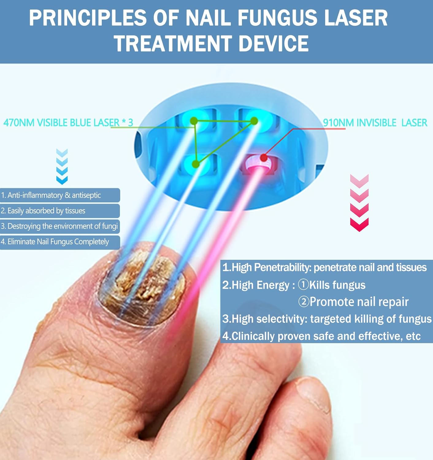 iKeener Nail Fungus Laser Treatment Device For Toenail, Fingernail Fungus Treatment Extra Strength With 407nm Blue Light& 905nm Laser To Treat Onychomycosis,Toe Nail Fungus Cleaning Removal At Home