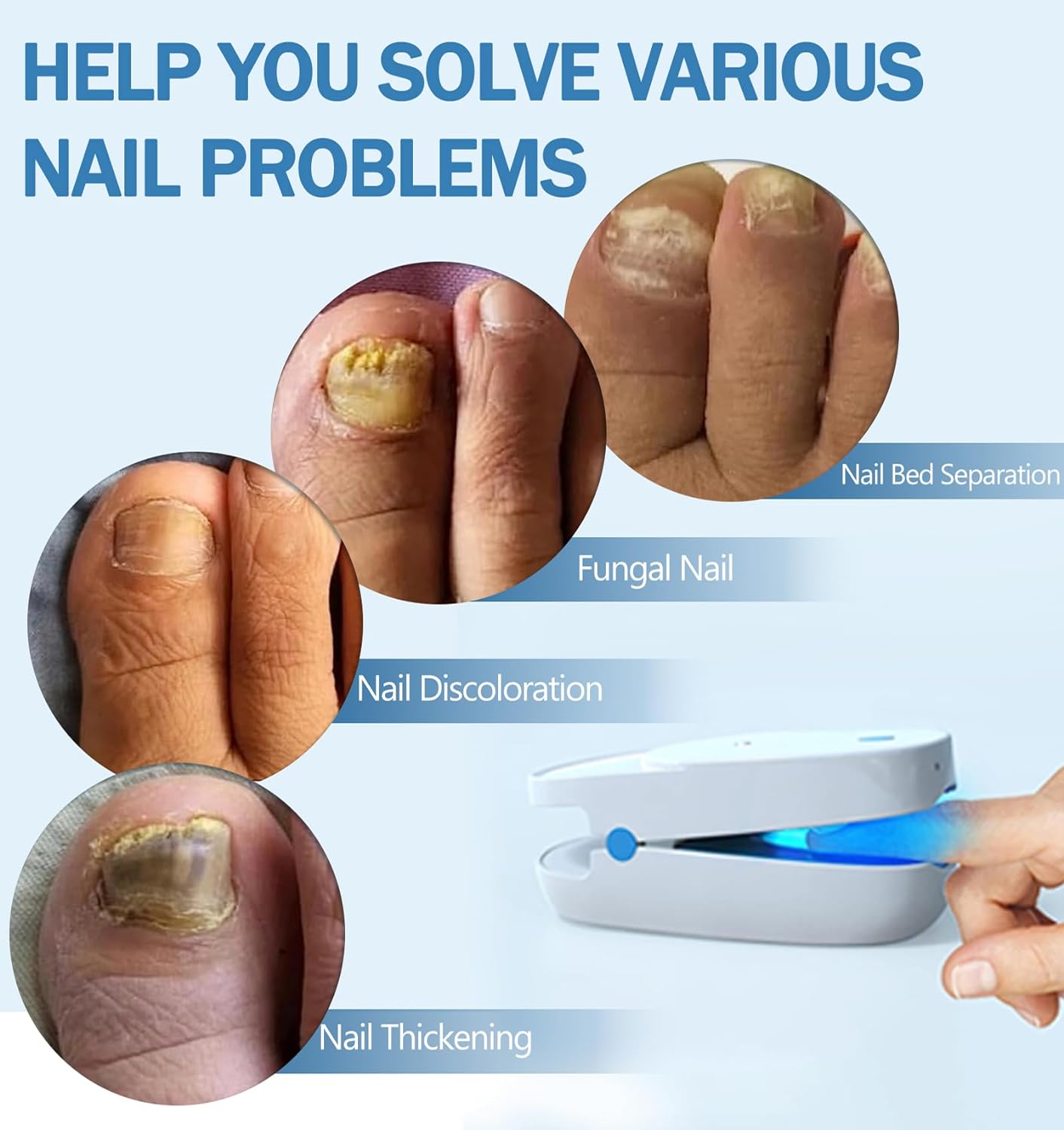iKeener Nail Fungus Laser Treatment Device For Toenail, Fingernail Fungus Treatment Extra Strength With 407nm Blue Light& 905nm Laser To Treat Onychomycosis,Toe Nail Fungus Cleaning Removal At Home