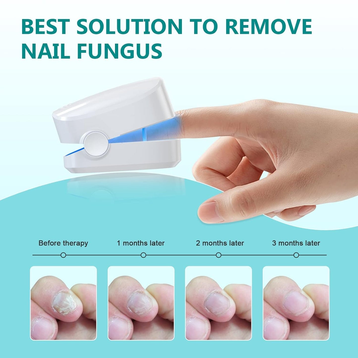 Anyork Toenail Fungus Treatment La ser Device Nail Fungus Treatment for Toe Nail Automatic Nail Fungal Cleaning Device Remover for Damaged Nails, 470nm Blue Light + 905nm Infrared Light Theapy