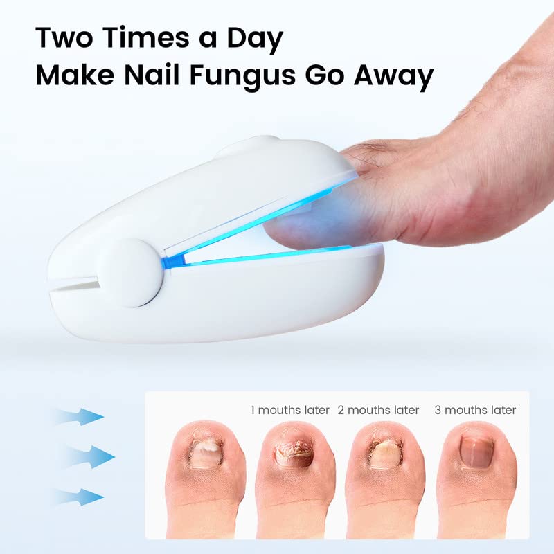 EIXIO Toenail Fungus Treatment Nail Fungus Cleaning LaserDevice for Onychomycosis Nail Fungal Treatment for Fingernail & Toenail Effective for Toe Fungus Nail Treatment