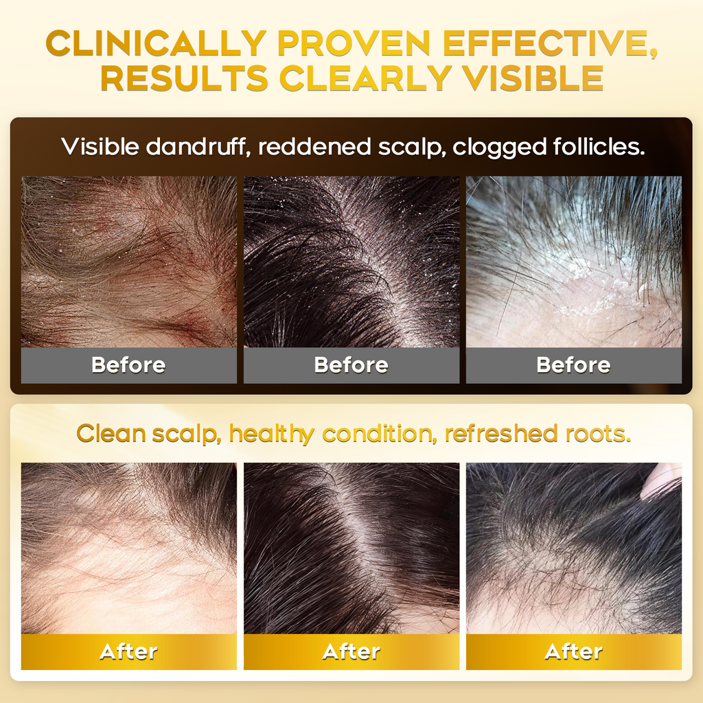 Enhanced Antifungal Shampoo for Seborrheic Dermatitis, Folliculitis & Scalp Psoriasis – Anti-Dandruff Shampoo for Men & Women, Relieves Itchy Dry Scalp, Sulfate & Paraben-Free, 10.1 Fl Oz-Fresh