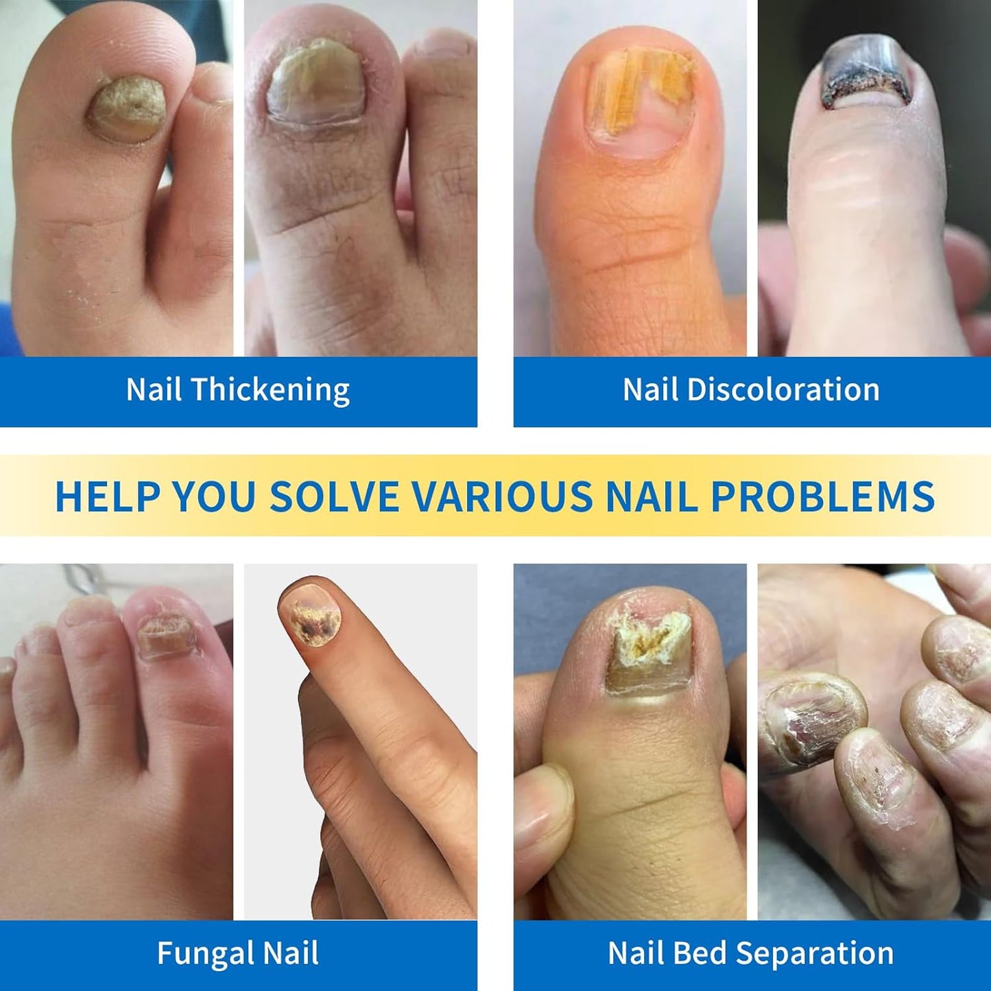 HaSoCare Nail Fungus Laser Treatment Device, Home Use Fungus Nail Treatment for Toenail and Fingernail, Blue Light Therapy for Onychomycosis Damaged Discolored Thick Toenail