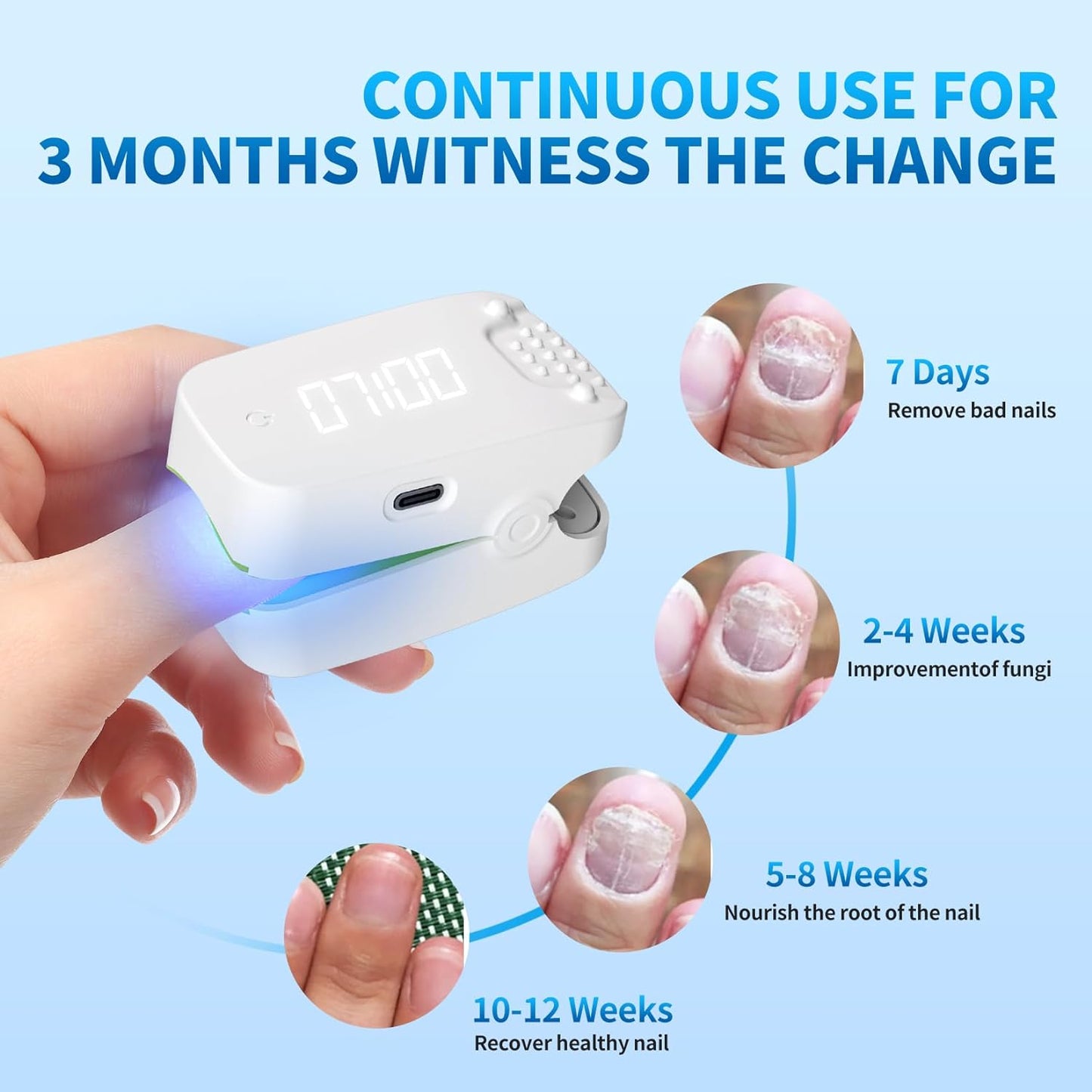Glitreniee Nail Fungus Laser Treatment Device for Fingernails and Toenails, Rechargeable Nail Fungus Cleaning Laser Device with Digital Led Display, Effective Nail Light Treatment for Home Use (White)