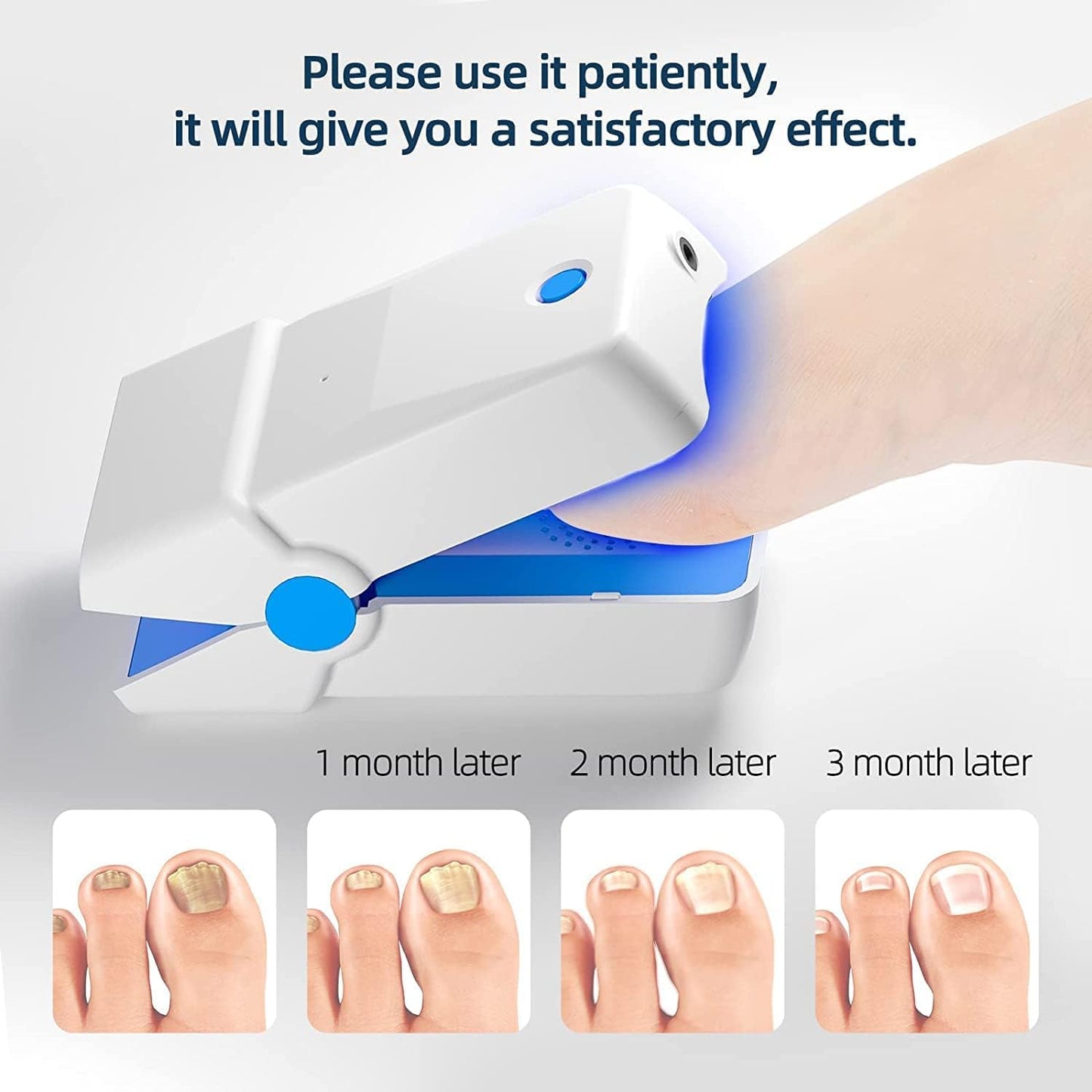 Highly Effective Cherrish Rechargeable Cherrish Nail Fungus Laser Treatment Device for Onychomycosis Cure. This Instrument is for Home use and Treats Nail Fungus and infections. Easy use and Fast Results.