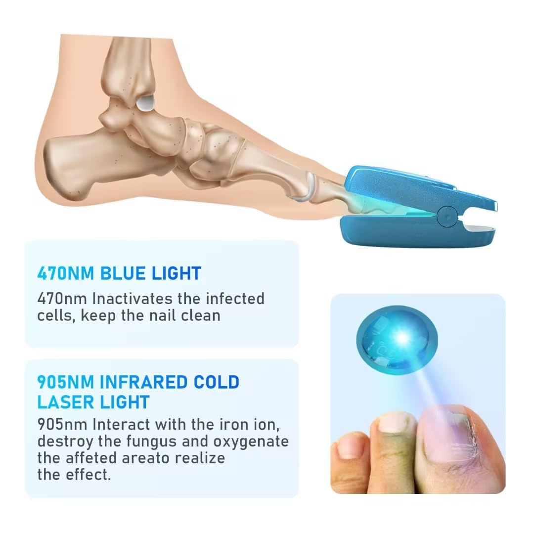 Jitesy Nail Fungus Laser Treatment, Onychom Laser Cleaning Device for Fingernails and Toenails, Toenail Fungus Treatment for Home Use