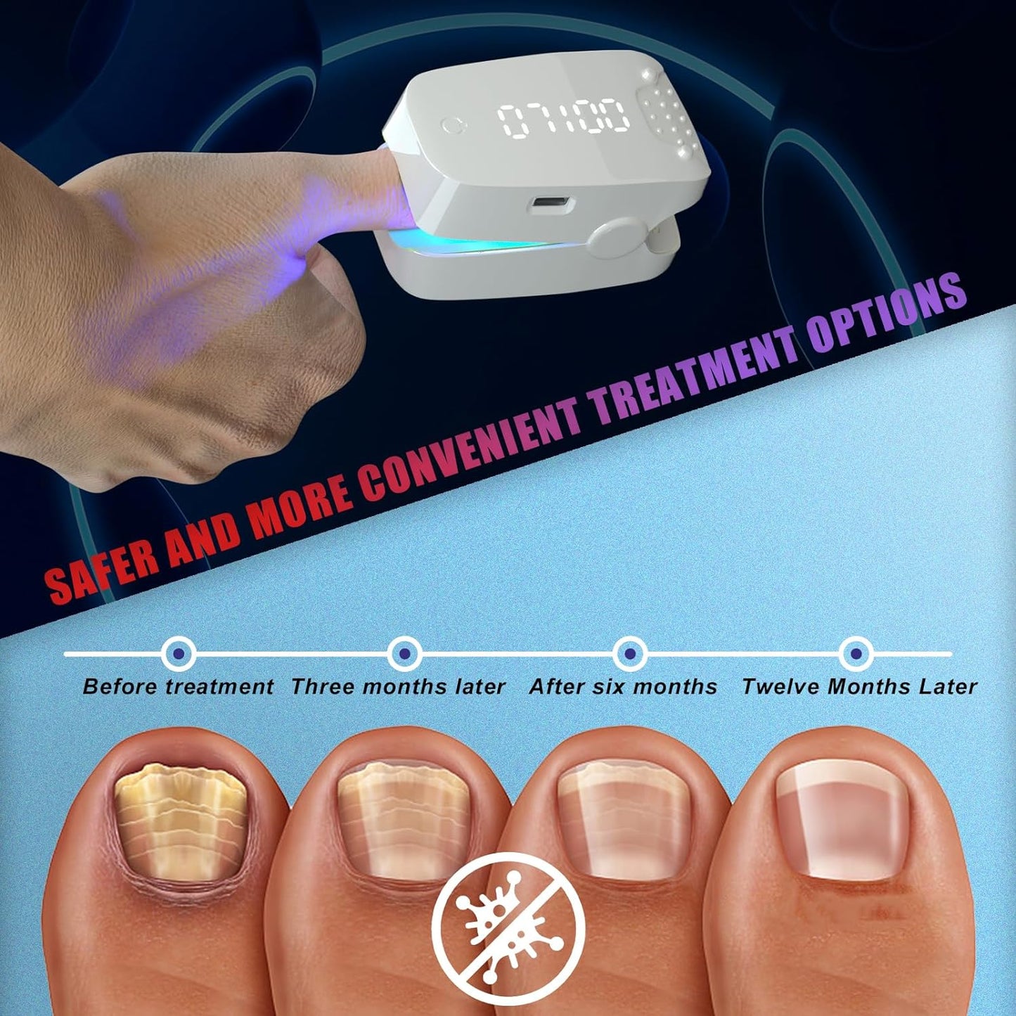 hanvate Nail Fungus Cleaning Laser Device,Efficient Laser Treatment For Nail Fungus，LED Screen, Automatic Timer