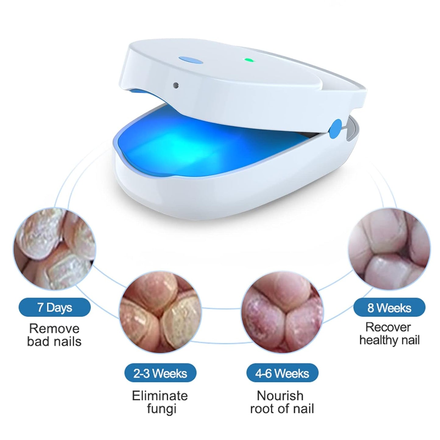 iKeener Nail Fungus Laser Treatment Device For Toenail, Fingernail Fungus Treatment Extra Strength With 407nm Blue Light& 905nm Laser To Treat Onychomycosis,Toe Nail Fungus Cleaning Removal At Home