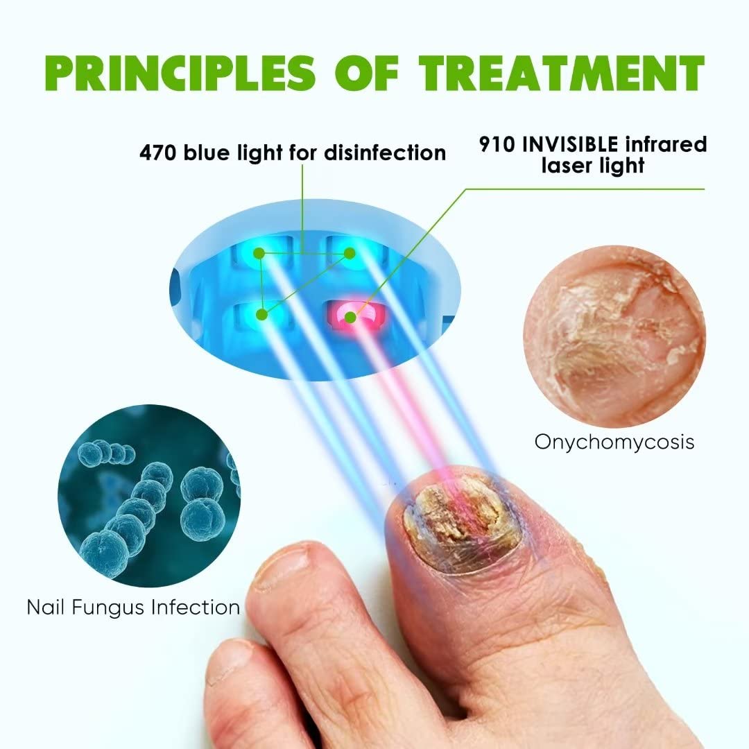 BORELTH Nail Fungus Laser Treatment for Toenails, FSA or HSA eligible Highly Effective Blue Light Laser Therapy to Treat Onychomycosis, Revolutionary Nail Fungus Treatment, Easy to Use at Home, Elderly