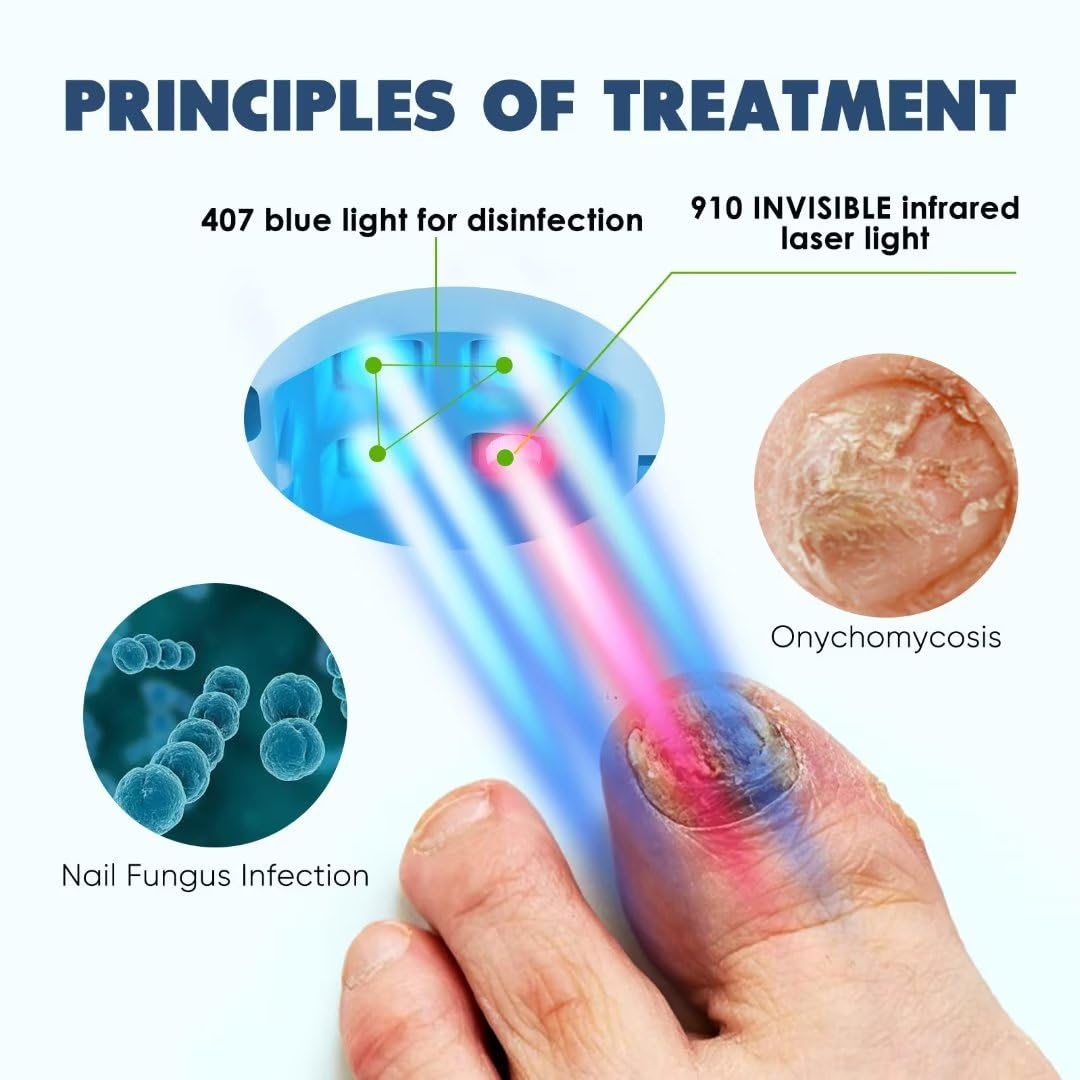 BORELTH Nail Fungus Laser Treatment LED Light Device, New Press Button-free Clip-on Design, Effective Convenient Nail Fungus Treatment for Toenails,Targets Damaged, Discolored and Thickened Toenails, Onychomycosis Buster