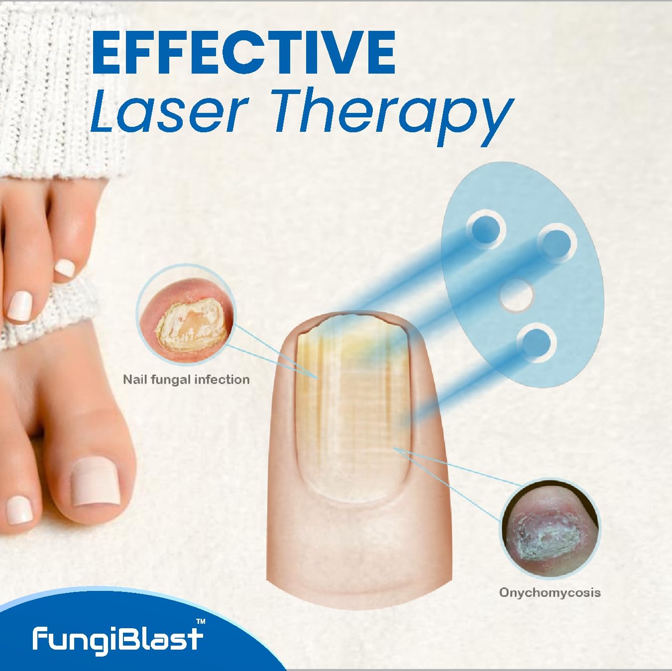 FungiBlast Nail Fungus Laser Treatment Device - Onychomycosis Laser Nail Treatment - Effective | Safe | Rechargeable home Laser Treatment for Damaged Discolored Unattractive Nails