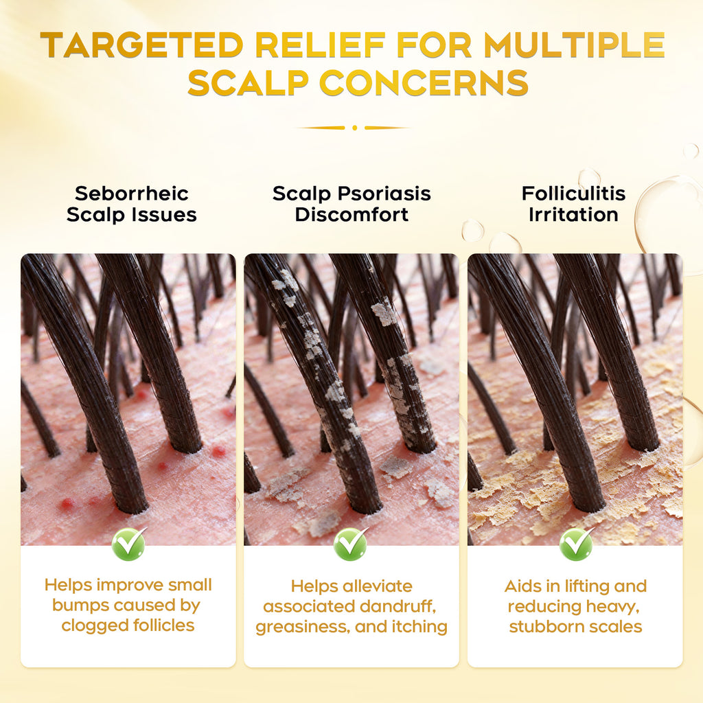 Enhanced Antifungal Shampoo for Seborrheic Dermatitis, Folliculitis & Scalp Psoriasis – Anti-Dandruff Shampoo for Men & Women, Relieves Itchy Dry Scalp, Sulfate & Paraben-Free, 10.1 Fl Oz-Fresh