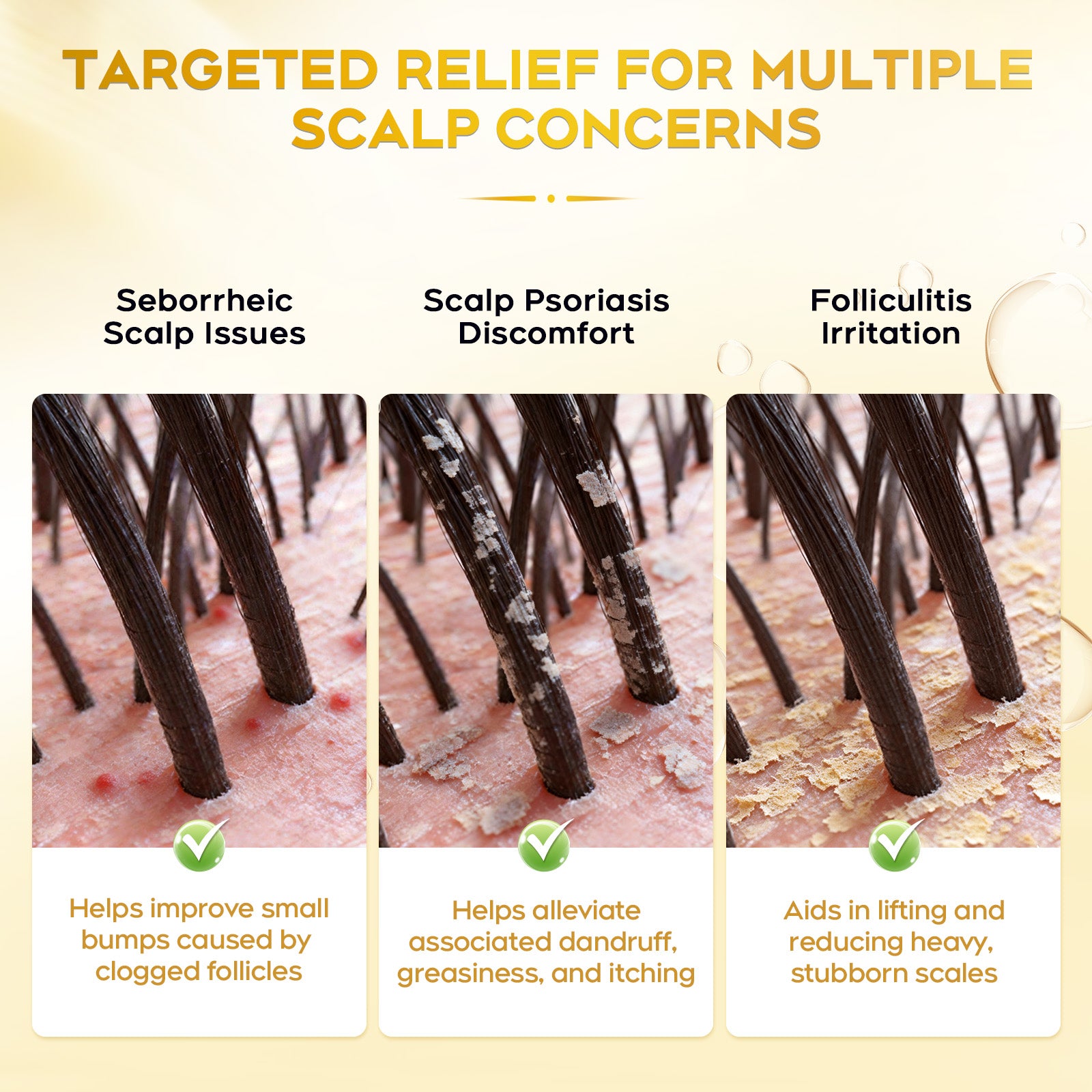 Enhanced Antifungal Shampoo for Seborrheic Dermatitis, Folliculitis & Scalp Psoriasis – Anti-Dandruff Shampoo for Men & Women, Relieves Itchy Dry Scalp, Sulfate & Paraben-Free, 10.1 Fl Oz-Fresh