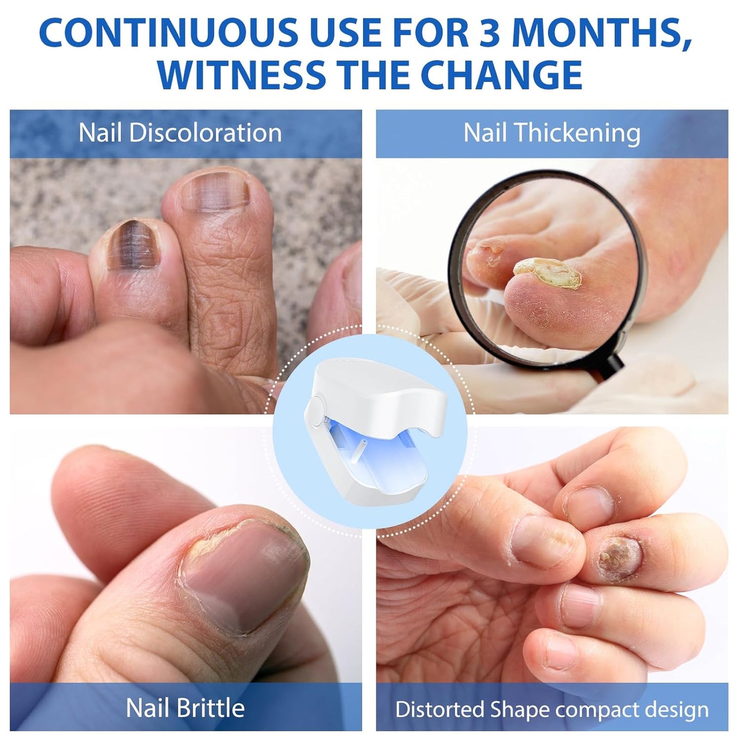 MAOYUE Nail Fungus Cleaning Laser Device Blue Light Nail Therapy for Onychomycosis Damaged Discolored Thick Toenails Fingernails Effective Light Therapy for Fingernails and Toenails Treated