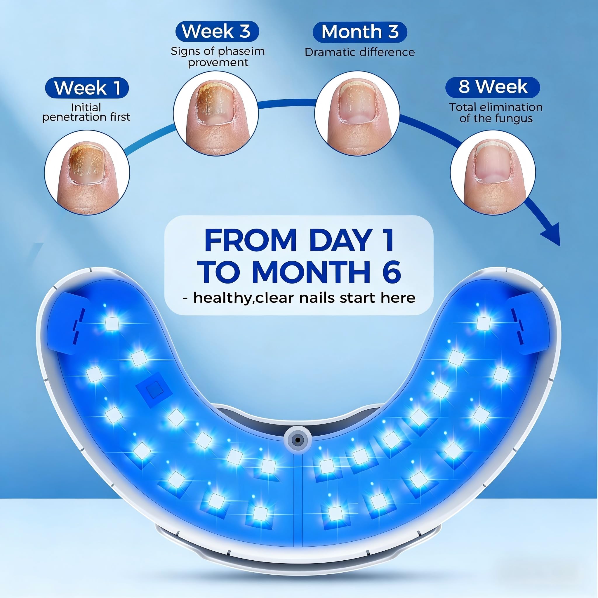 Nail Fungus Laser Treatment LED Light Device-Nail Fungus Light Device,Effective Rechargeable Nail Fungus Remover-Blue 1 Count (Pack of 1)