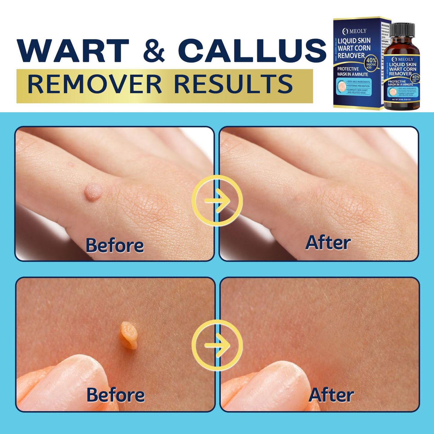 Fast-Acting Wart Remover: 40% Salicylic Acid Wart Remover Maximum Strength for Plantar Wart, Corn Men and Women