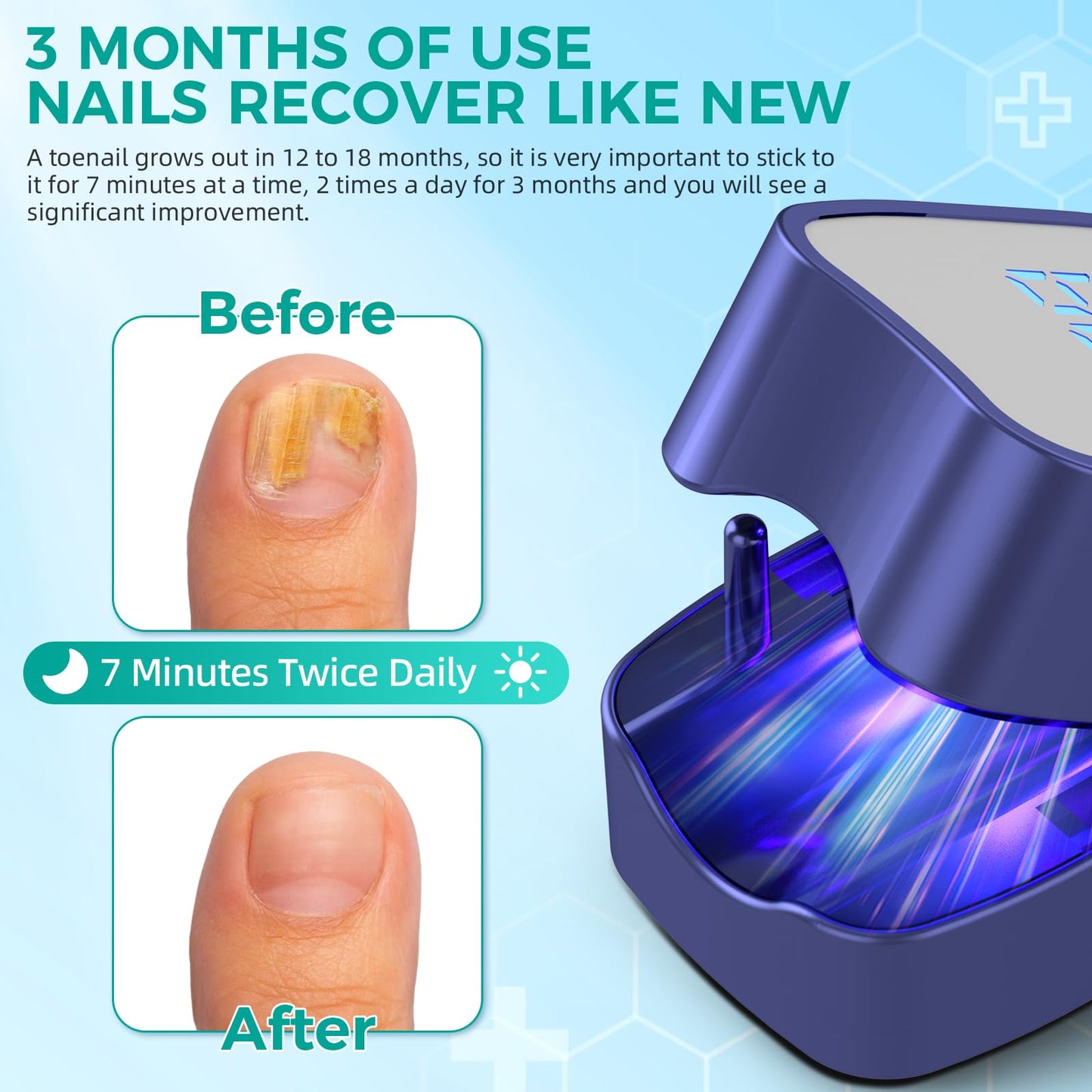 Nail Fungus Laser Treatment LED Light Device