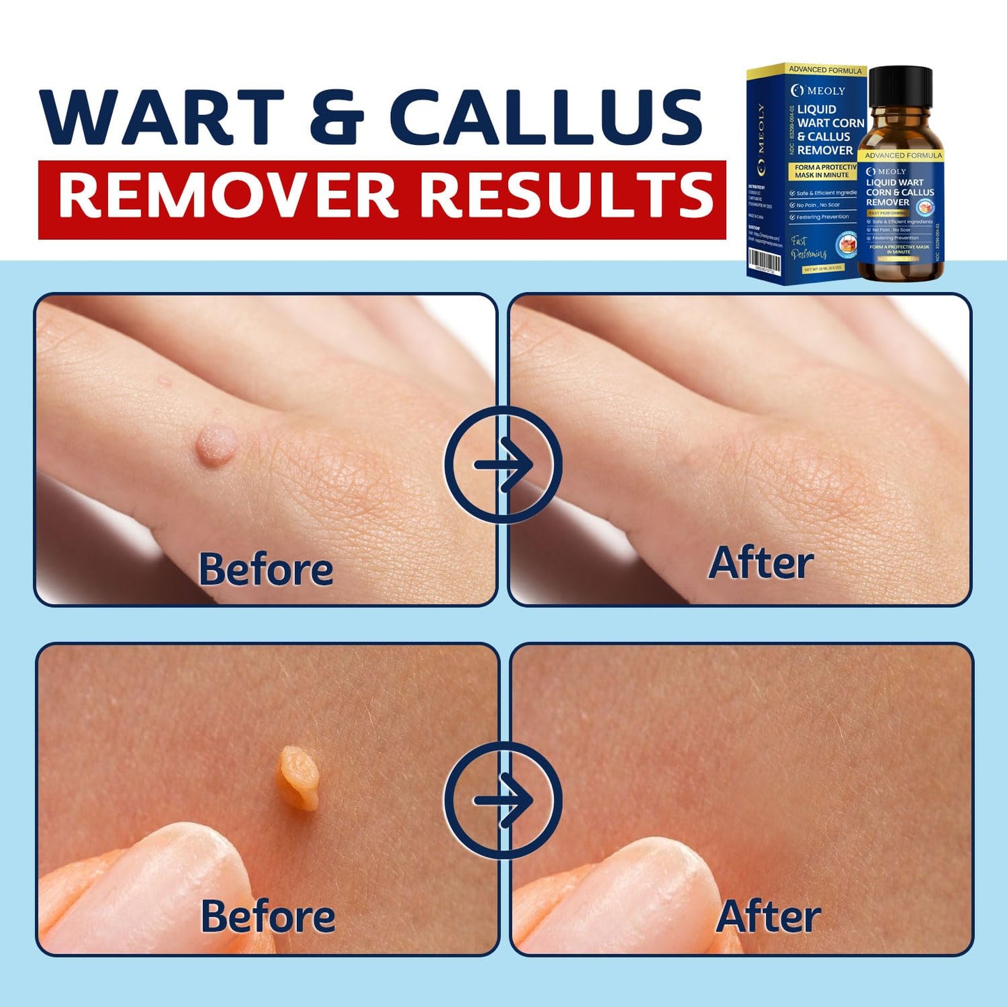 Fast-Acting Wart Remover Freeze Off : Salicylic Acid Wart Remover for Plantar Wart, Corn Freeze Off Fast-Acting for Men and Women 30 ML