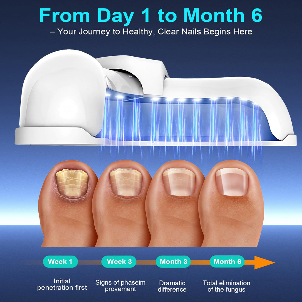 Nail Fungus Laser Treatment LED Light Device-Portable Design,Suitable For Fingernails And Toenails White 2 Fl Oz (Pack of 1)